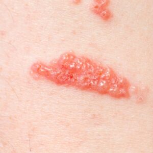 Contact Dermatitis