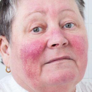 Rosacea