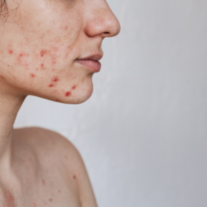 Acne Scars