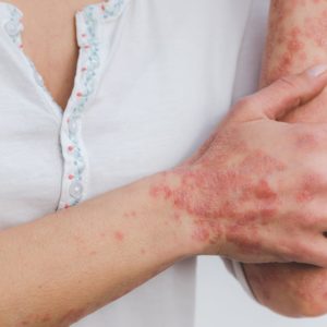 Psoriasis